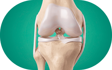 Ilustração da Lesão do ligamento cruzado anterior